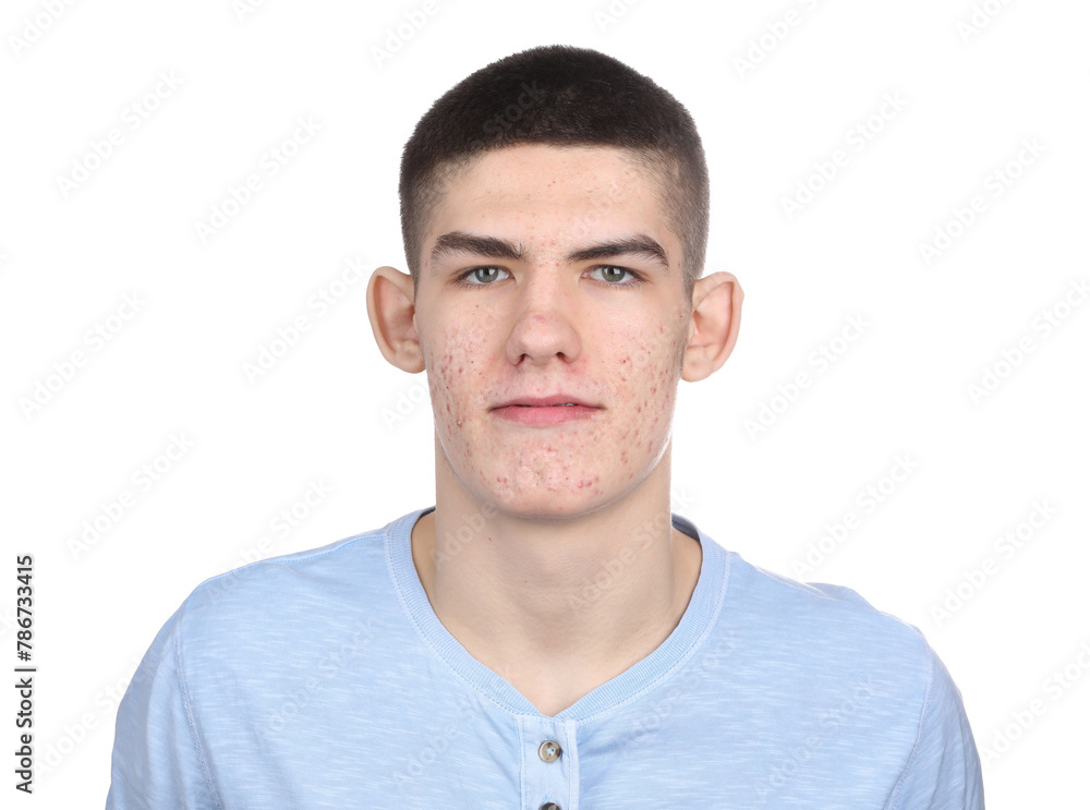 Young man with acne problem isolated on white Young man with acne problem isolated on white
