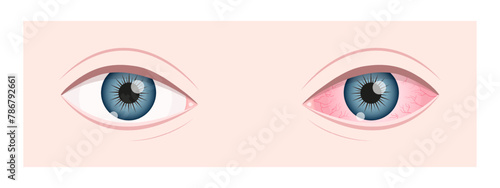 Healthy and ill human vision organ. Dry eye syndrom. Inflamed eyeball with irritation and red conjunctiva. Symptoms of keratitis, blepharitis, conjunctivitis or uveitis. Vector flat illustration.