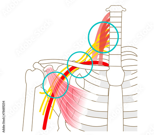Three gaps that cause thoracic outlet syndrome