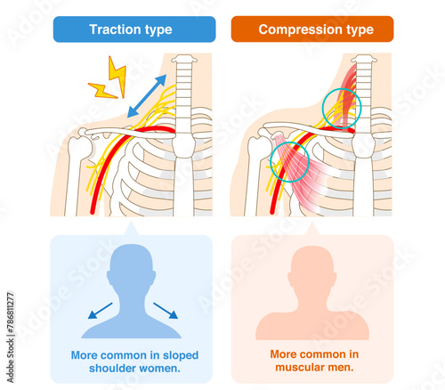 Two types of thoracic outlet syndrome, traction and compression photo