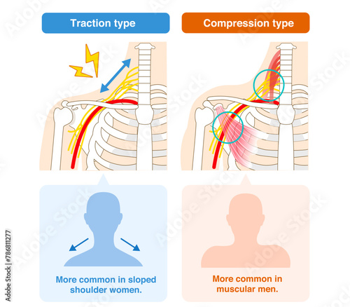 Two types of thoracic outlet syndrome, traction and compression
