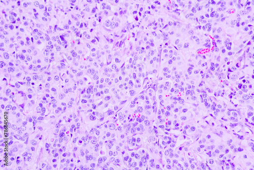 Backgrounds of human cells tissue of lung human under the microscope in pathology lab.View in microscopic of ductal cell carcinoma, adenonocarcinoma from human breast cancer, tissue section by H and E