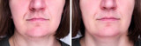 Woman's face with moustache and hairs on chin. Before and after hair removal and epilation.