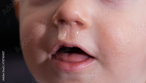 Yellow snot from a child s nose, close-up. Sinus infections, colds and virus. Chronic runny nose, adenoviruses