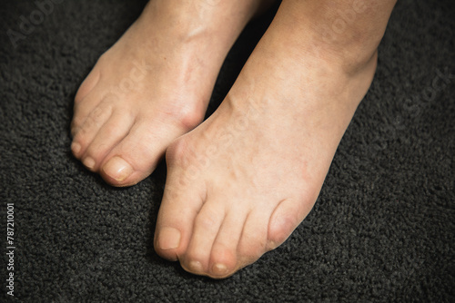 Flat feet and foot toe problems, What Problems Can Flat Feet Cause. High quality photo. 