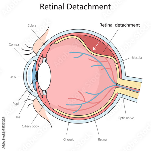 human eye anatomy showcasing retinal detachment, including cornea, lens, and optic nerve structure diagram hand drawn schematic vector illustration. Medical science educational illustration