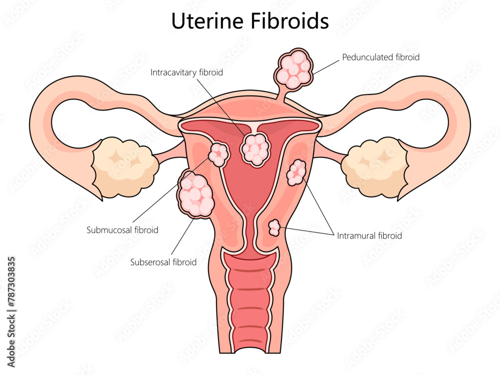 Human various types of uterine fibroids, including submucosal ...