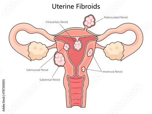 Human various types of uterine fibroids, including submucosal, subserosal, and intramural fibroids structure diagram hand drawn schematic vector illustration. Medical science educational illustration