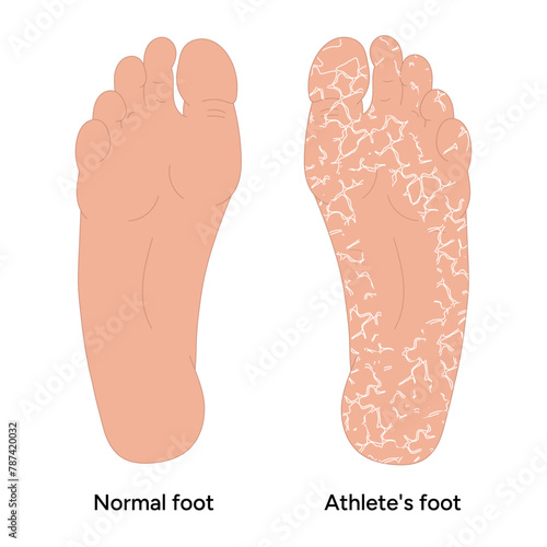 Normal and athletes foot. Shelling foot. Podiatrist disease 