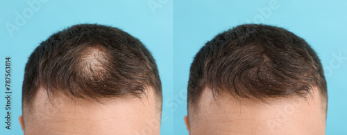 Young man before and after hair loss treatment on light blue background, closeup