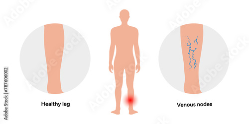 Normal and Varicose veins
