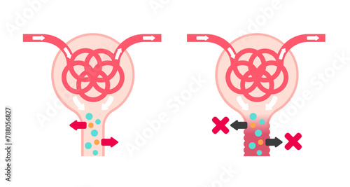 Fanconi syndrome causes vector illustration