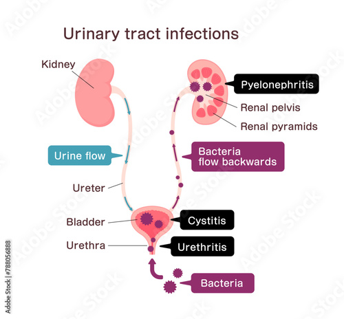 Urinary tract infection vector illustration