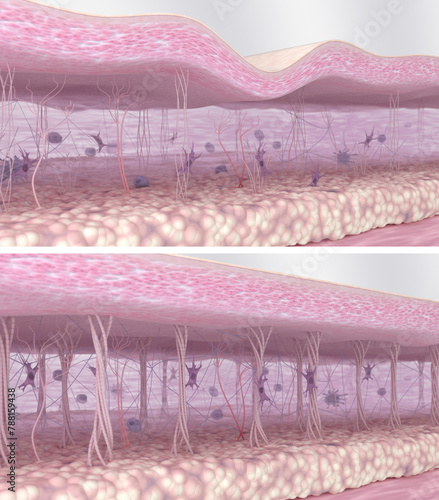 Collagen fibers regeneration in the skin tissues. Wrinkled skin before and smooth skin after anti-aging treatment or cosmetics action. Comparison of 3D illustrations of young and aged skin  photo