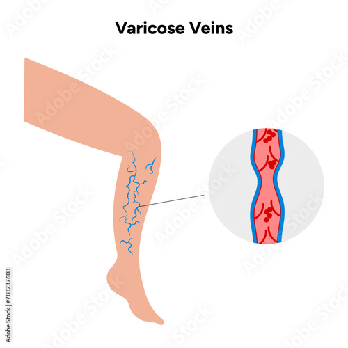 Varicose veins