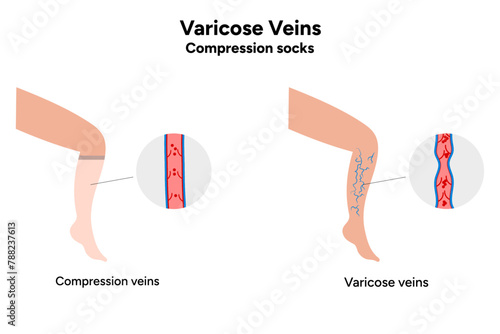 Compression socks and Varicose veins