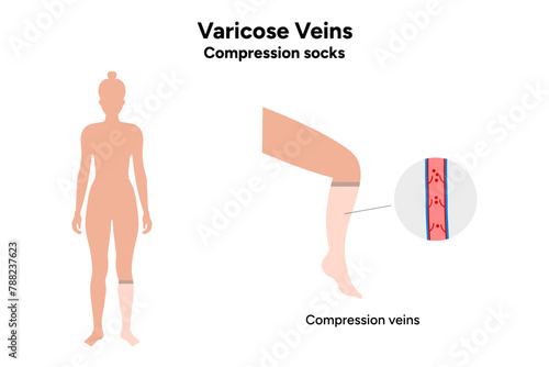 Compression socks and Varicose veins