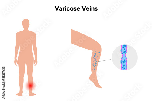  Varicose veins