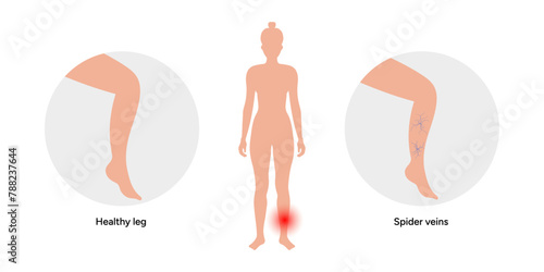 Normal and Spider veins