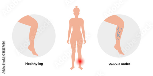 Healthy and  Varicose veins