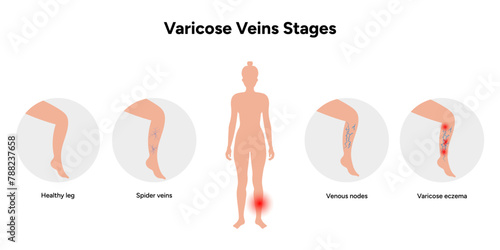 Varicose vein. Healthy leg and spider veins, venous nodes, varicose eczema. Varicose veins stages