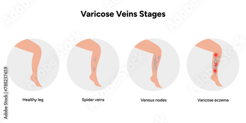 Varicose vein. Healthy leg and spider veins, venous nodes, varicose eczema. Varicose veins stages
