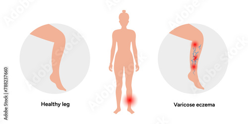 Normal and Varicose eczema veins