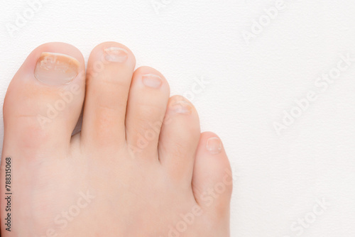 Young adult woman barefoot on white background. Dry damaged toe nails. Closeup. Top down view.	