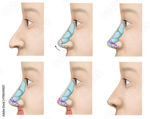 rhinoplasty photo