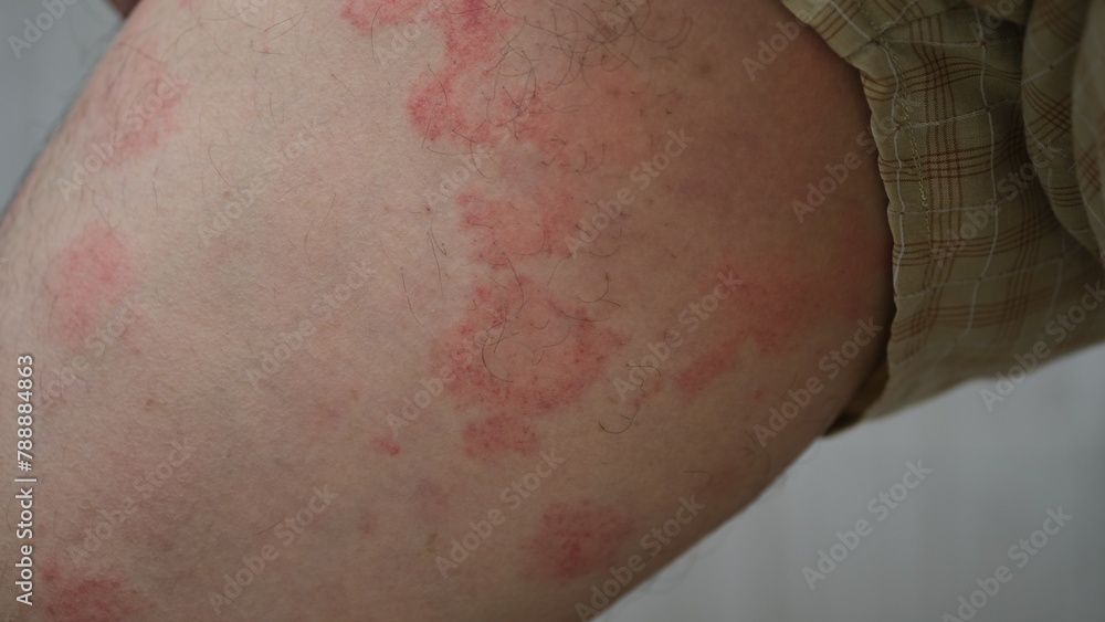 Fototapeta premium Close up image of skin texture suffering severe urticaria or hives or kaligata on a man's thighs. Allergy symptoms.