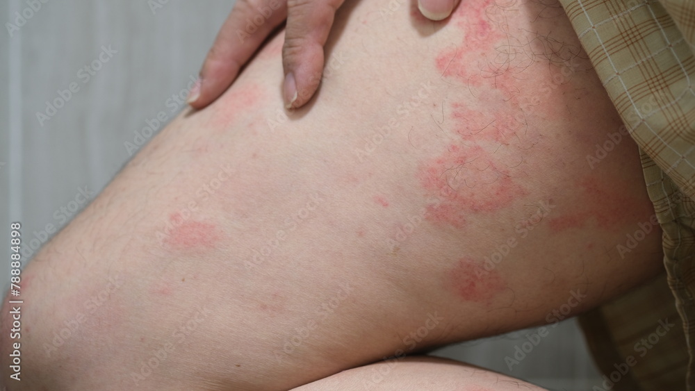 Naklejka premium Close up image of skin texture suffering severe urticaria or hives or kaligata on a man's thighs. Allergy symptoms.