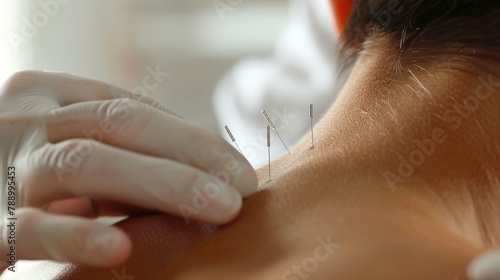 Acupuncture Therapy Back Close-Up
