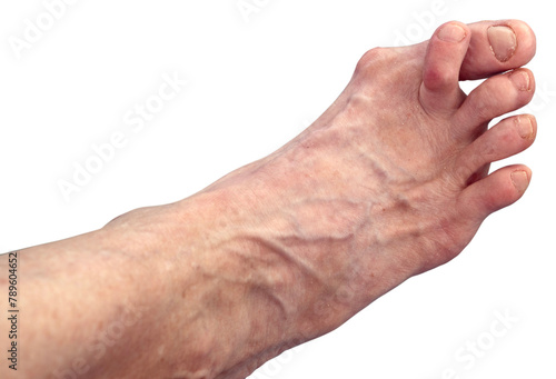 Isolated woman's hammer toe and bunion.