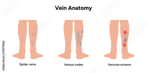 Spider veins, Venous nodes, Varicose eczema 