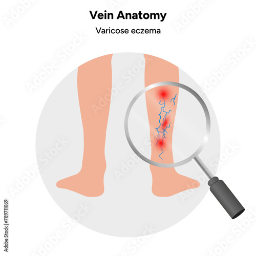 Vein anatomy zoom, varicose eczema 