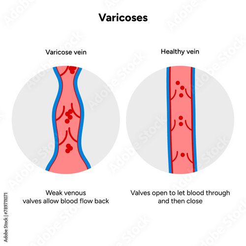 Varicose and healthy veins