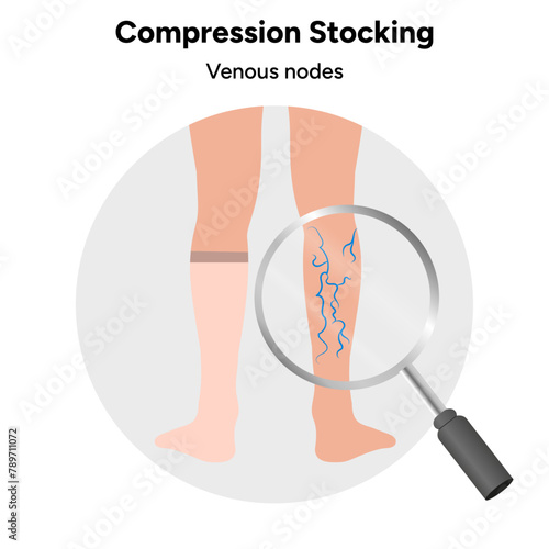 Compression stocking, venous nodes