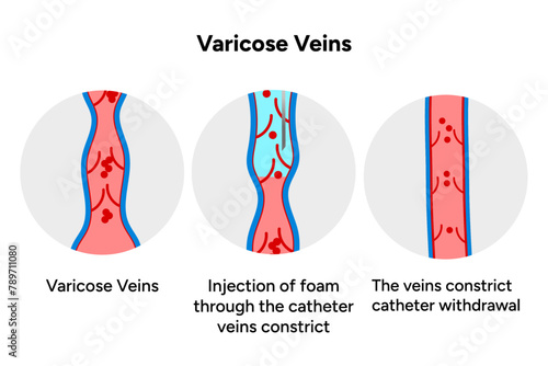 Normal and Varicose vein treatment, Sclerotherapy 