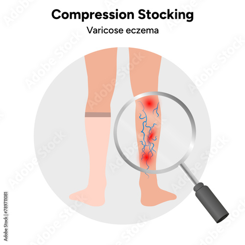 Compression stocking, varicose eczema 