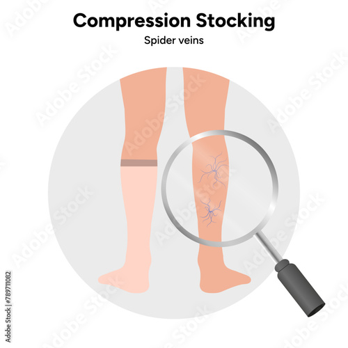 Compression stocking, spider veins zoom