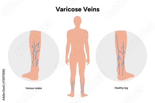 Varicose and healthy veins