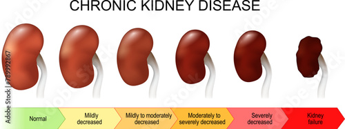 Chronic kidney disease. Stage of disorder