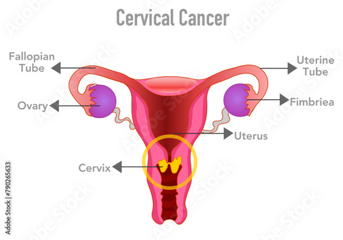 Cervical, gynecologic cancer . Woman reproduction anatomy. Female disease, reproductive system. Oviduct, ovary, vagina, uterus, cervix. Vector illustration photo