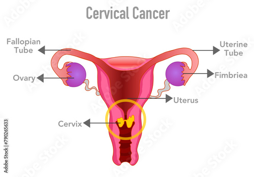 Cervical, gynecologic cancer . Woman reproduction anatomy. Female disease, reproductive system. Oviduct, ovary, vagina, uterus, cervix. Vector illustration