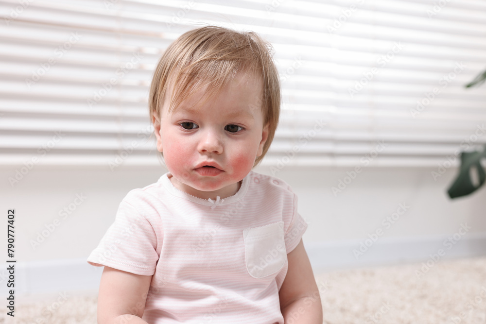 Portrait of little girl with diathesis symptom on cheeks indoors Portrait of little girl with diathesis symptom on cheeks indoors
