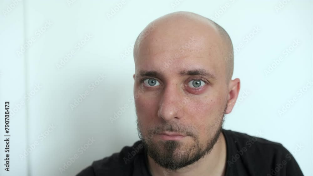 Close-up of a person with a swollen lower eyelid, indicating a chalazion or barley on the eye. Medical and health concept for educational material and diagnostics Close-up of a person with a swollen lower eyelid, indicating a chalazion or barley on the eye. Medical and health concept for educational material and diagnostics