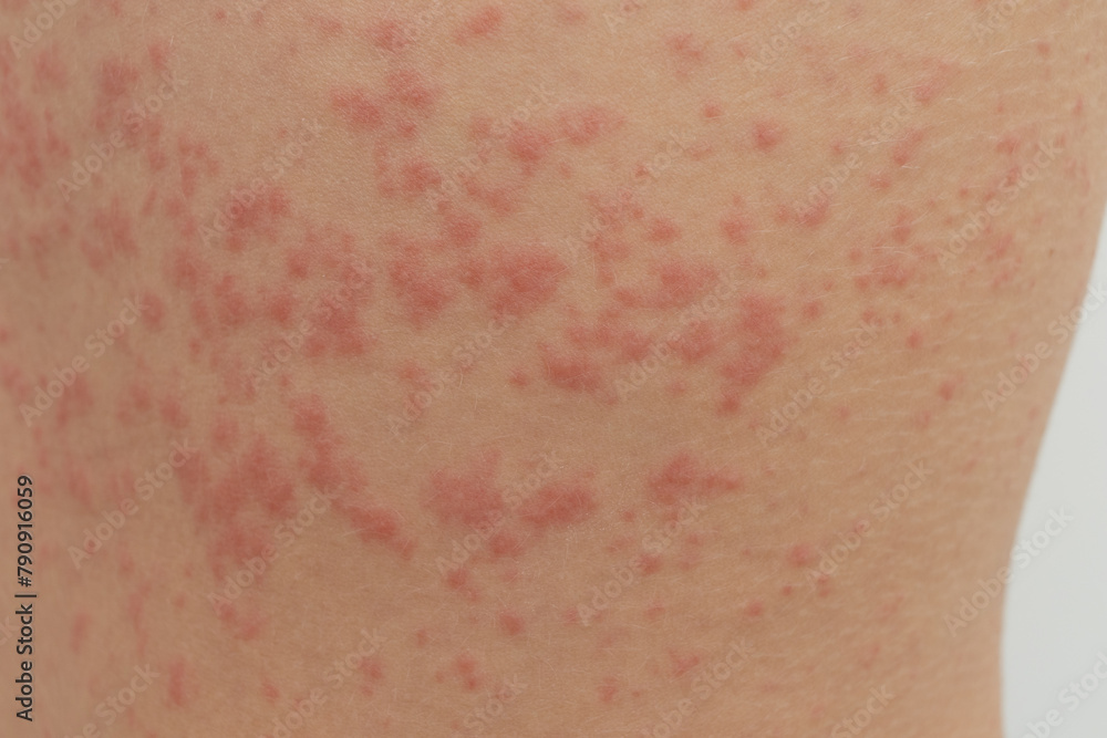 Fototapeta premium acute Urticaria allergy on woman's back
