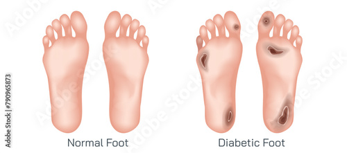 Diabetic foot refers to a group of complications that can arise in the feet of individual with diabetes mellitus. Peripheral arterial disease poor circulation of blood to the limbs vector illustration photo