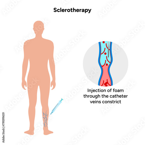 Normal and Varicose vein treatment, Sclerotherapy 