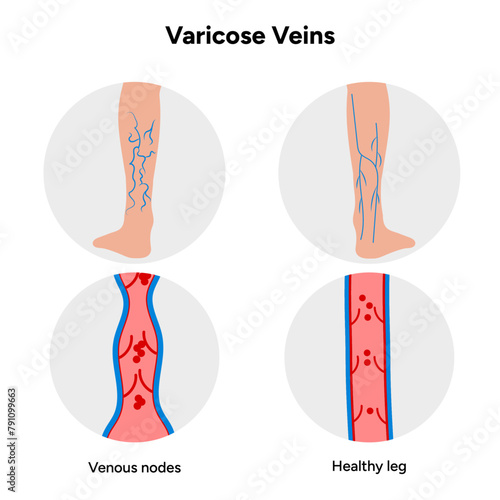 Varicose veins, venous nodes, healthy leg